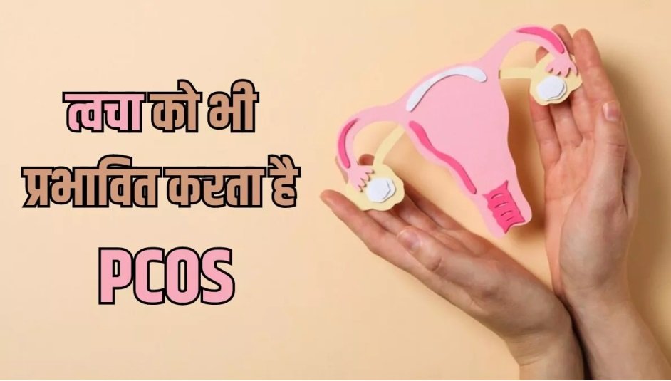 PCOS में सिर्फ मुंहासे ही नहीं ये समस्याएं भी पहुंचा सकती हैं आपकी त्वचा को नुकसान।